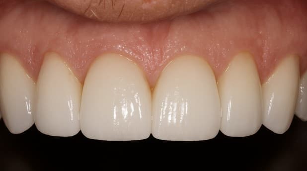After dental bridge treatment