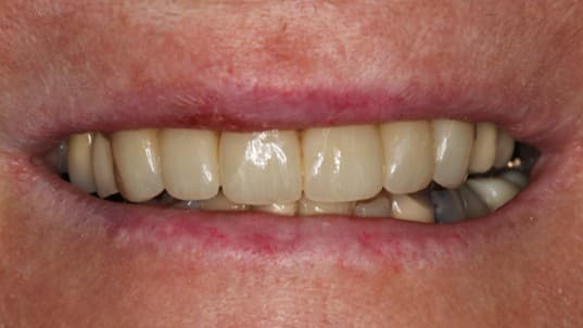 After dental bridge treatment