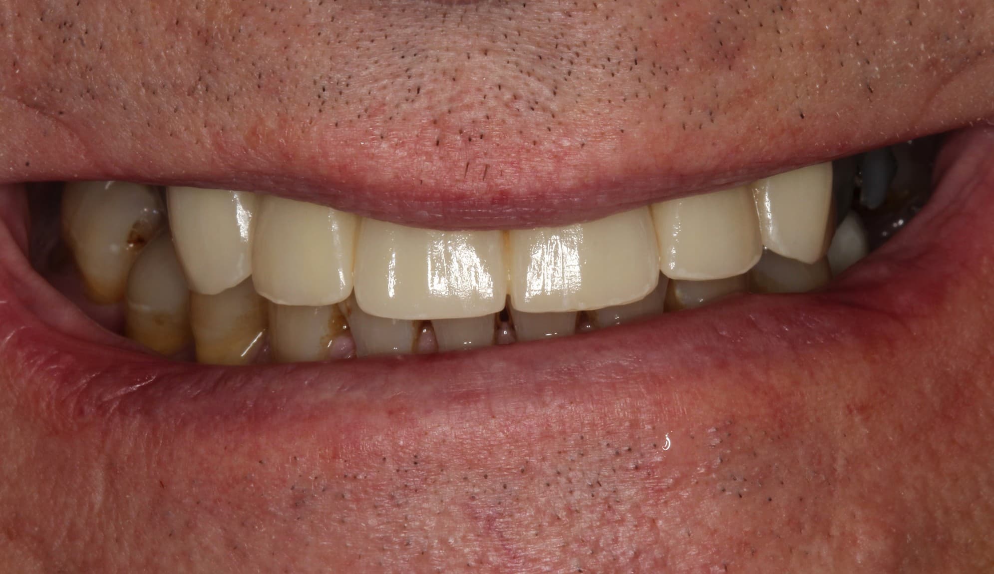 After dental bridge treatment