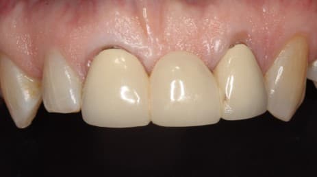 Before dental bridge treatment