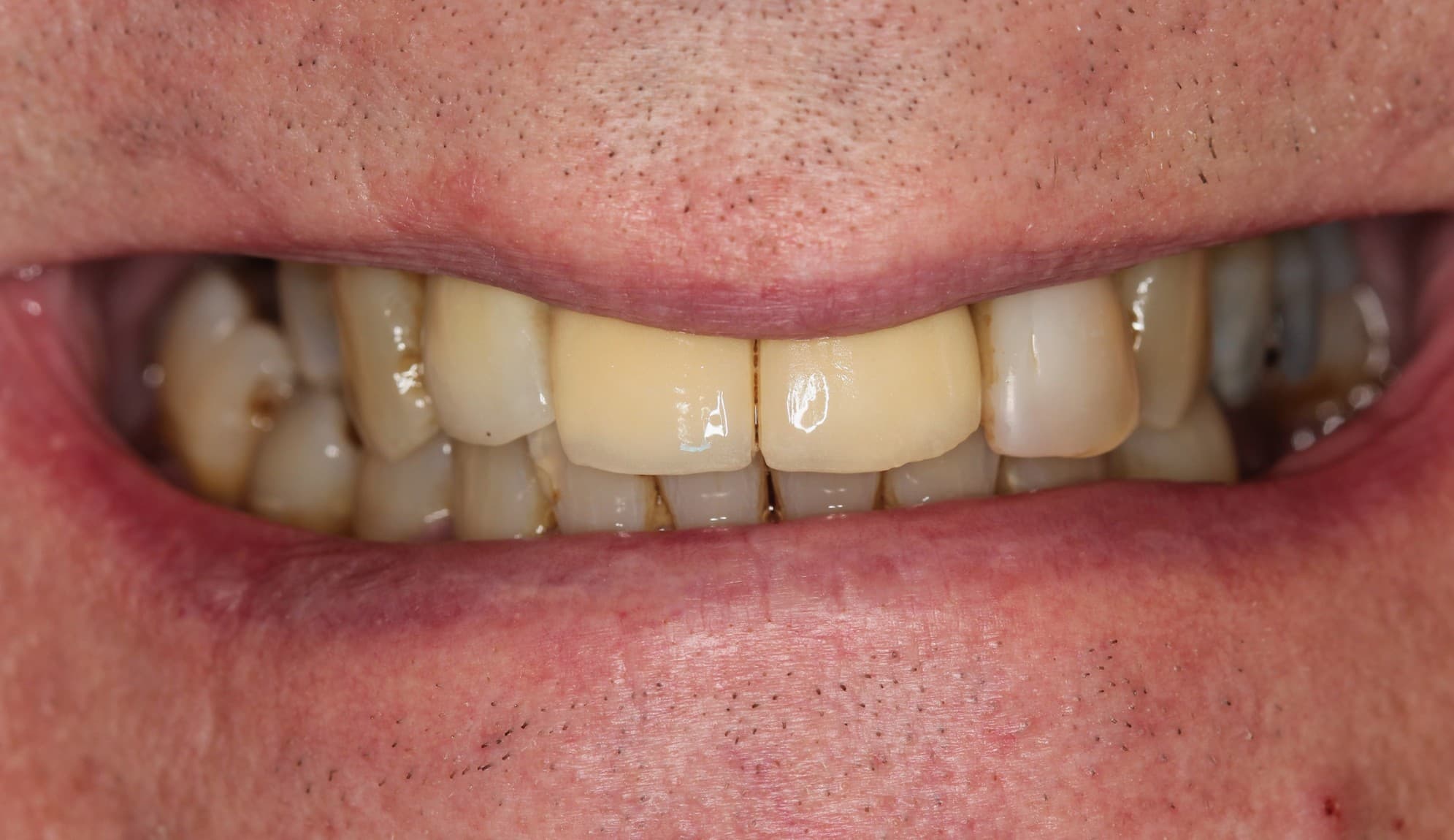 Before dental bridge treatment