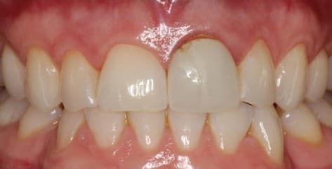 Before ceramic crown treatment
