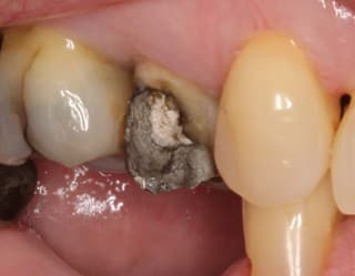 Before ceramic crown treatment