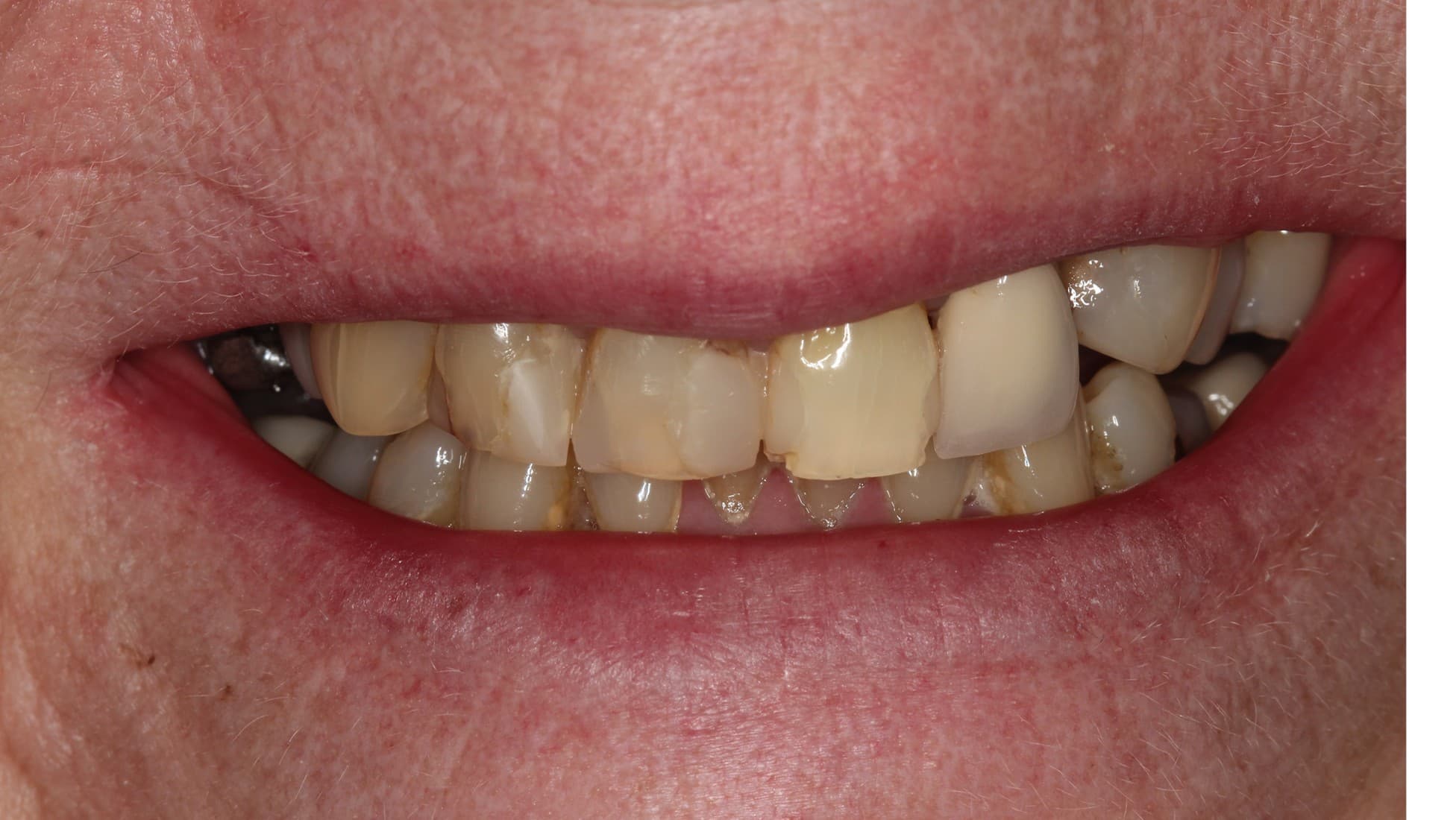 Before full ceramic rehabilitation treatment