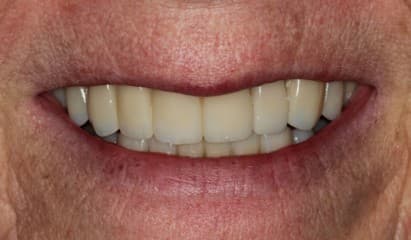 After full ceramic rehabilitation treatment