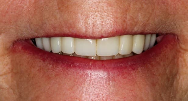 After ceramic restoration treatment