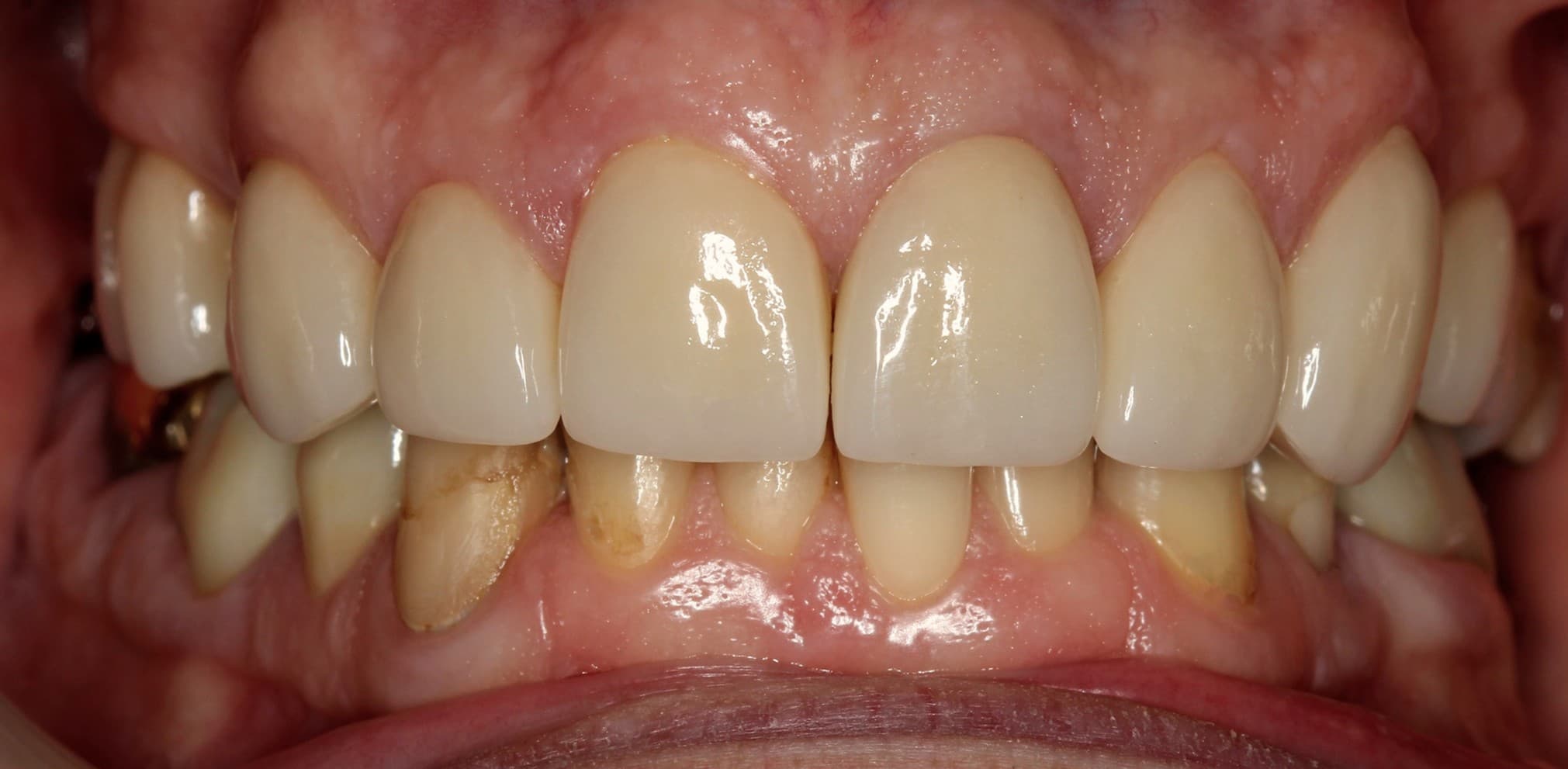 After ceramic restoration treatment