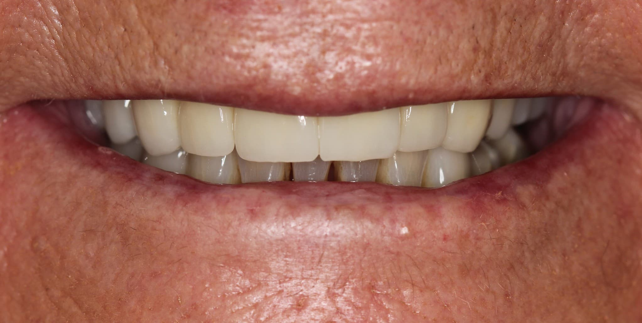 After ceramic restoration treatment