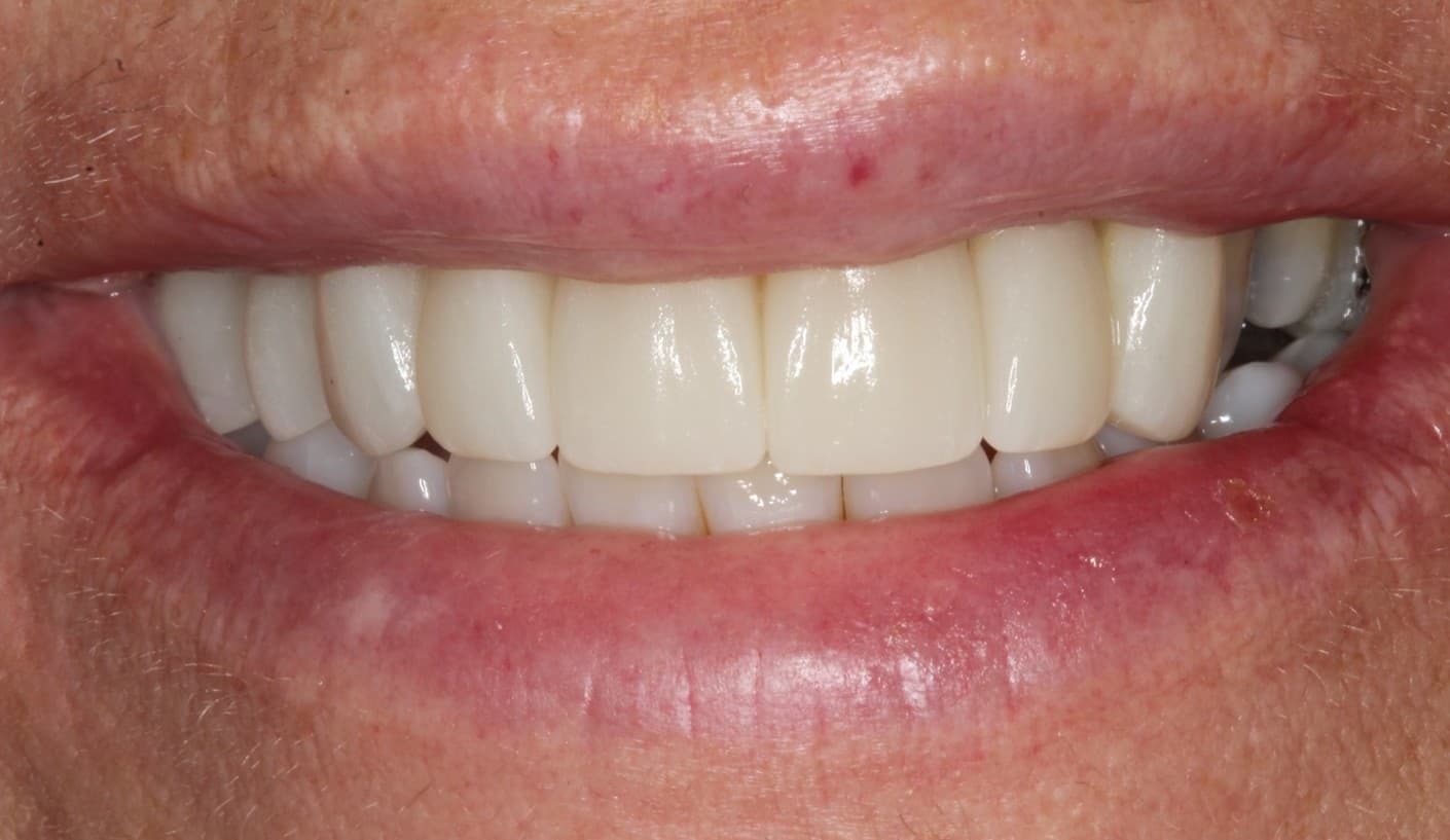 After ceramic restoration treatment
