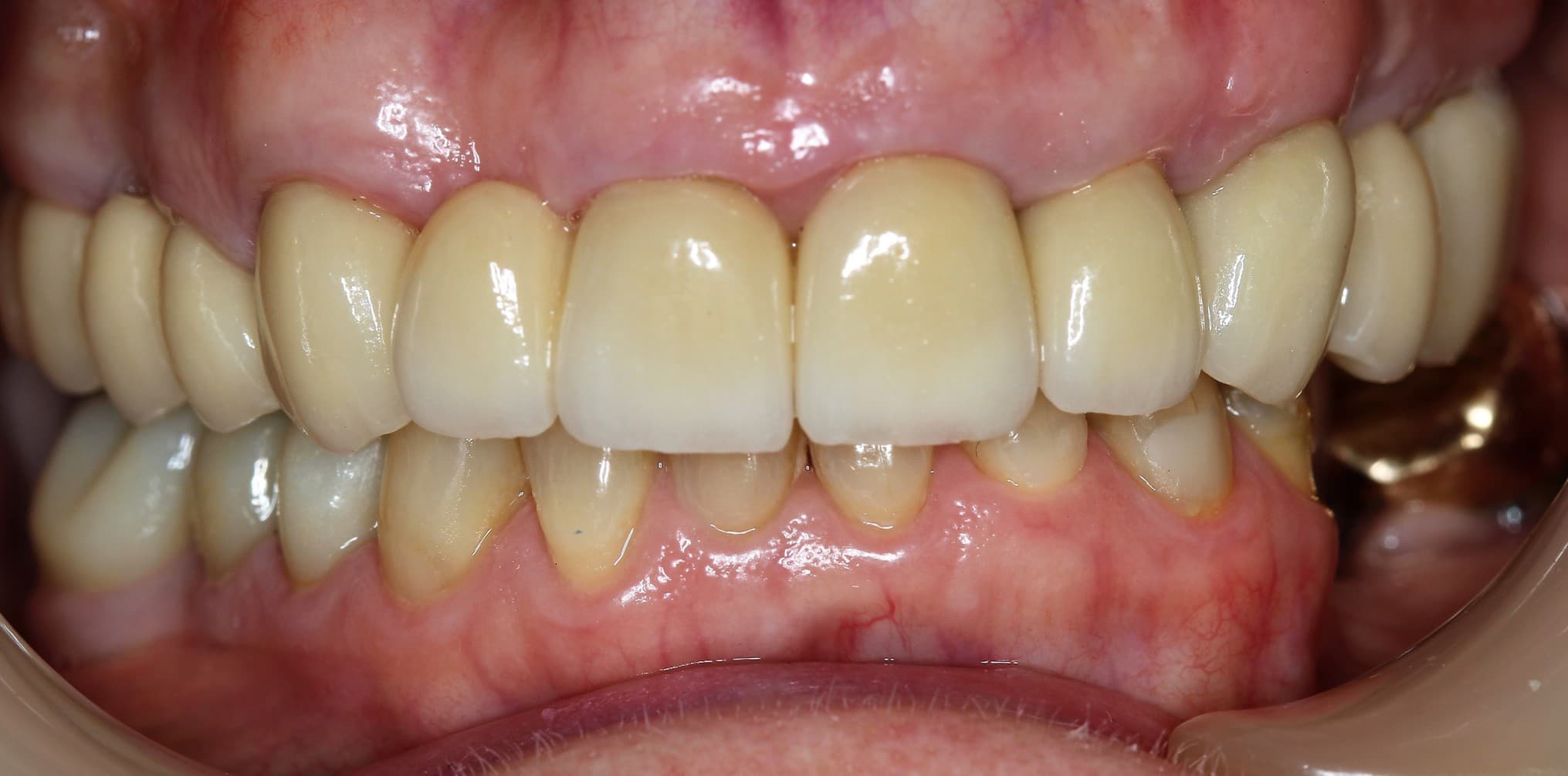 After ceramic restoration treatment