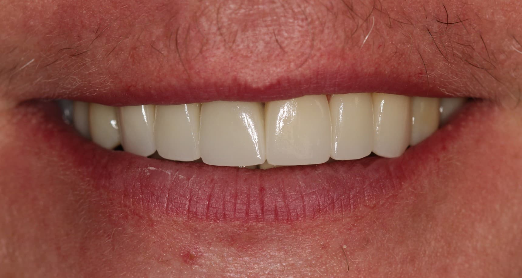 After ceramic restoration treatment
