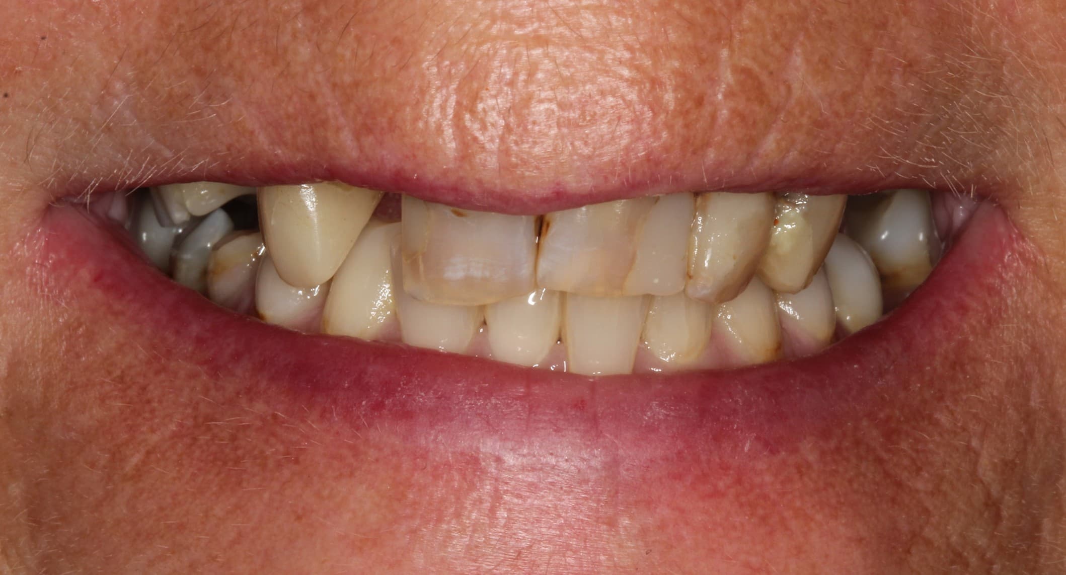 Before ceramic restoration treatment
