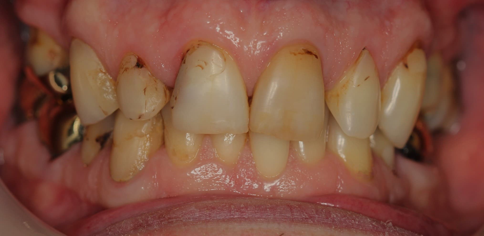 Before ceramic restoration treatment