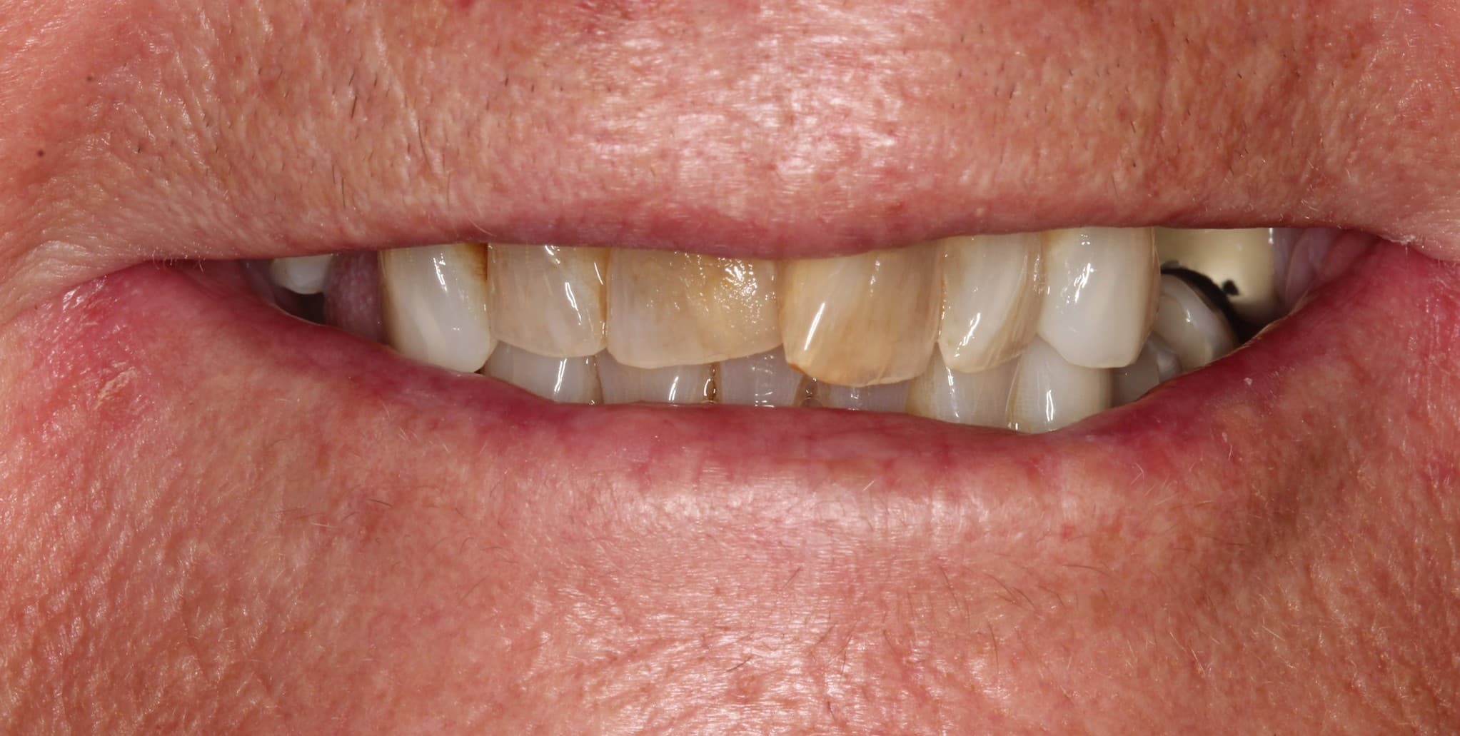 Before ceramic restoration treatment