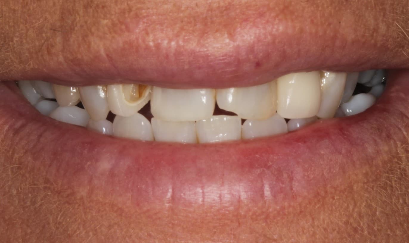 Before ceramic restoration treatment