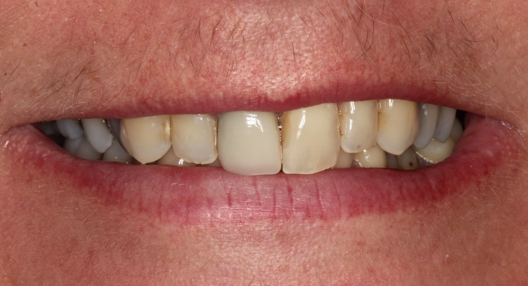 Before ceramic restoration treatment