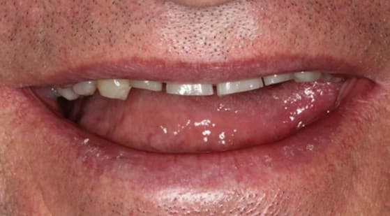 Before ceramic restoration treatment