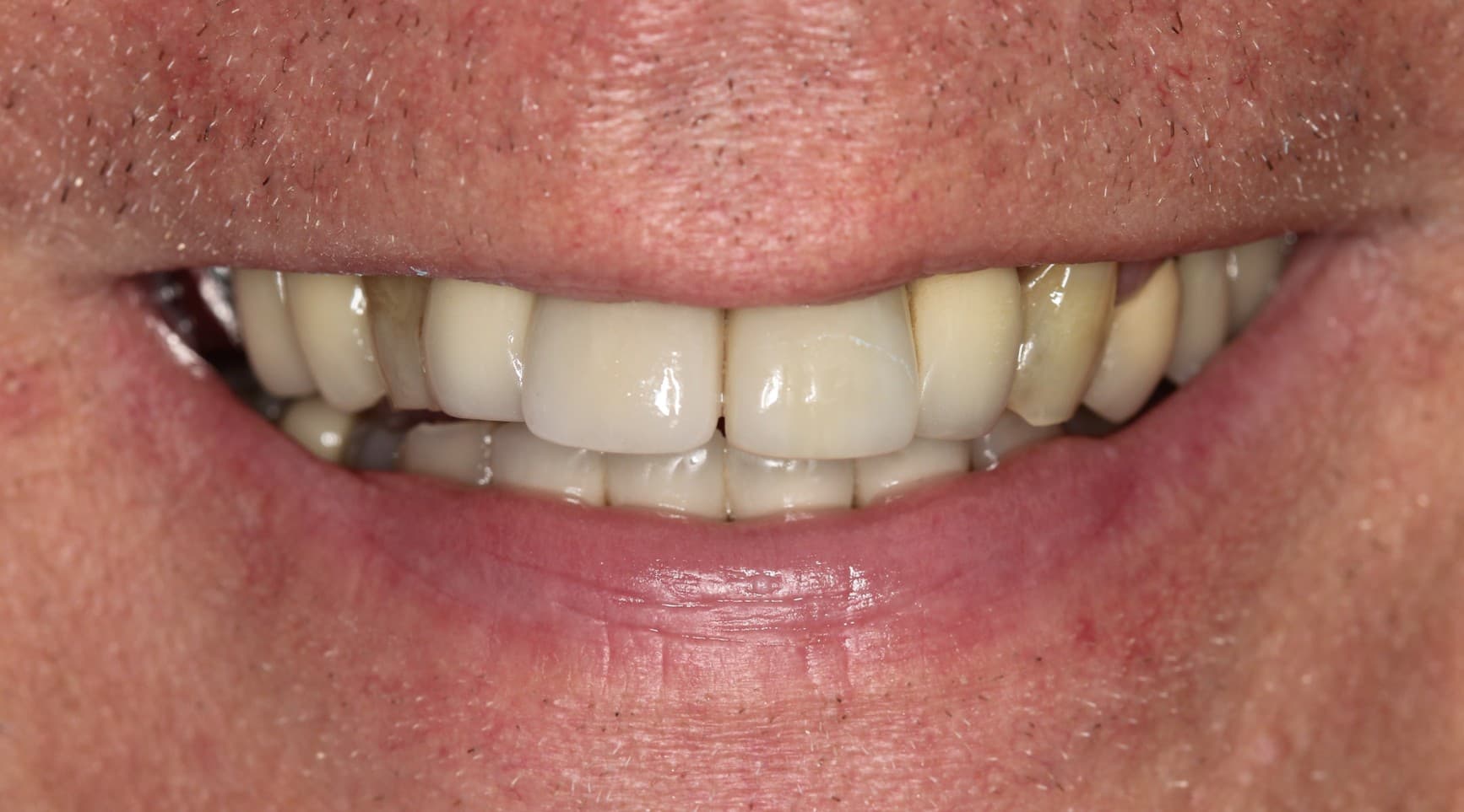 Before ceramic restoration treatment