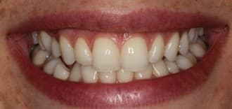 Before composite bonding treatment
