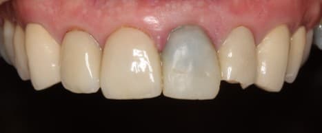 Before crown restoration treatment