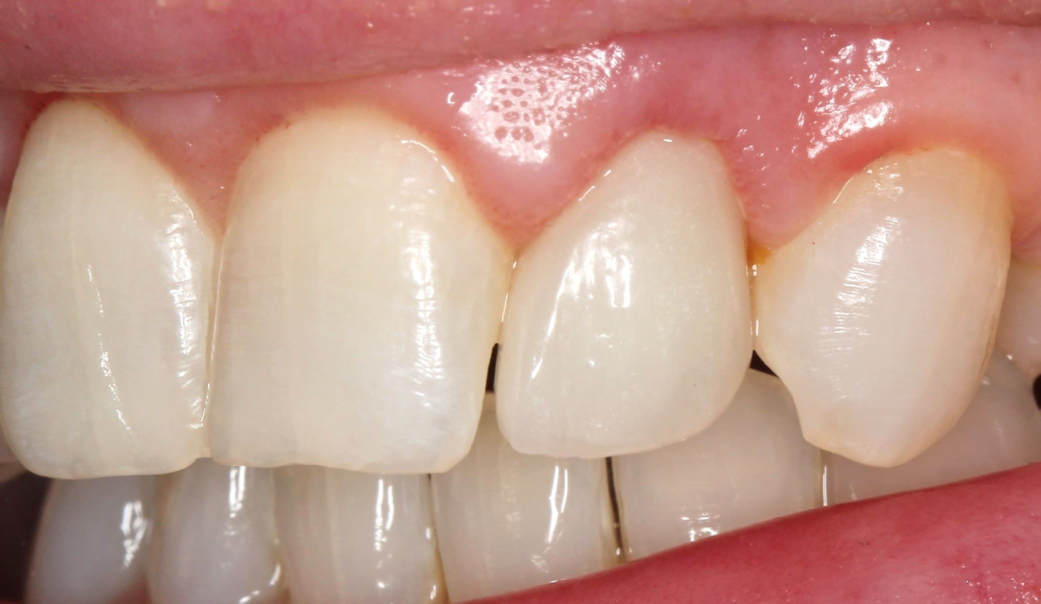 After crown lengthening treatment