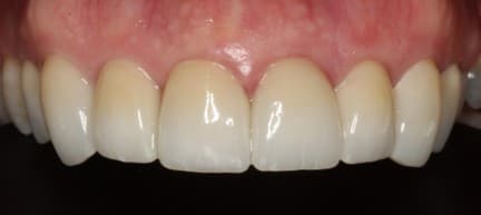 After crown restoration treatment