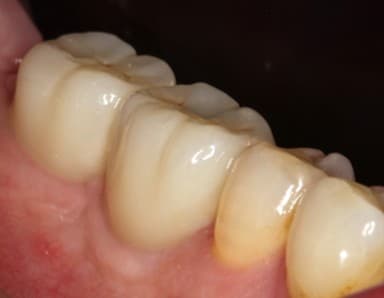 After dental implants treatment
