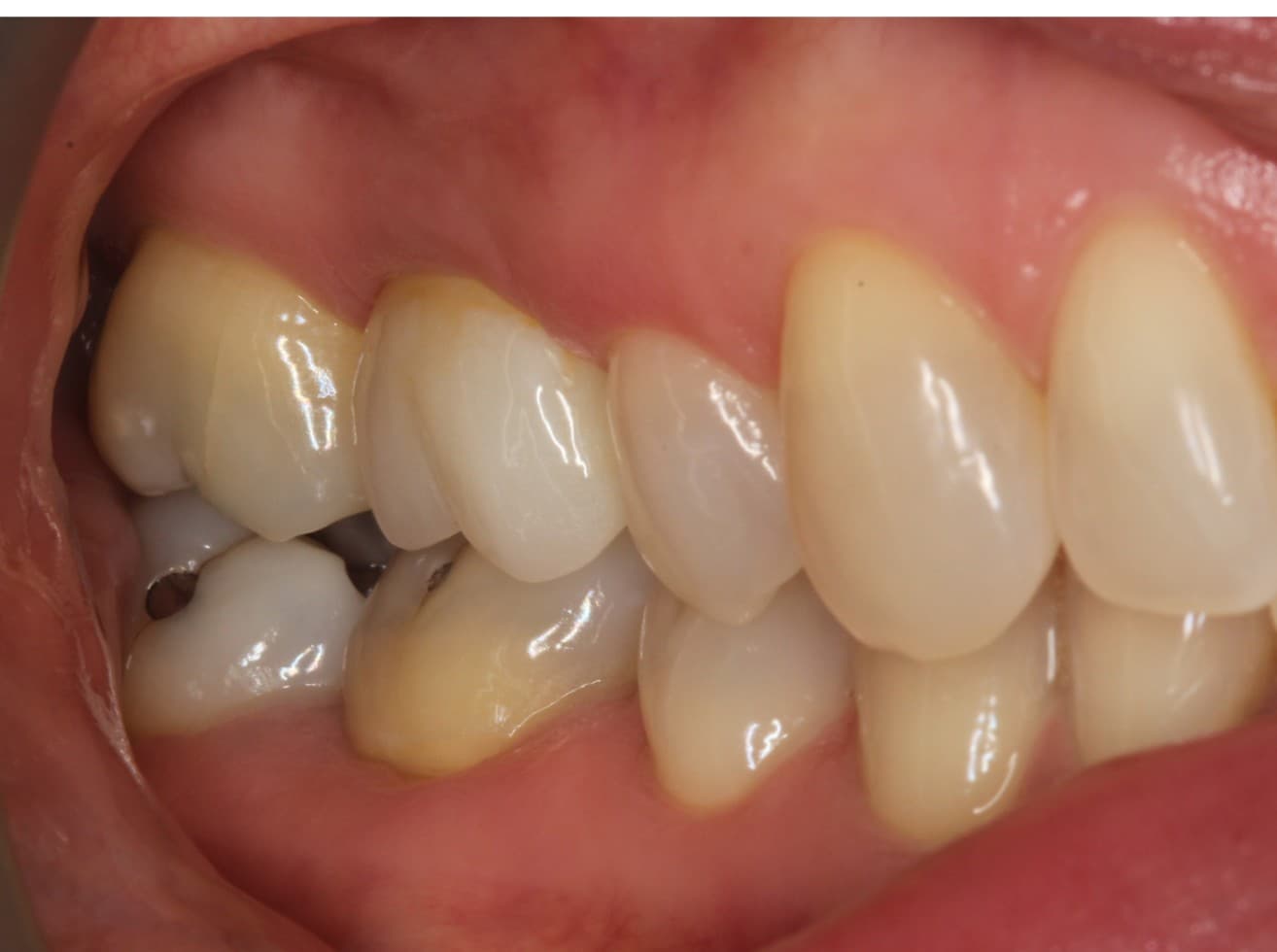 After dental implants treatment