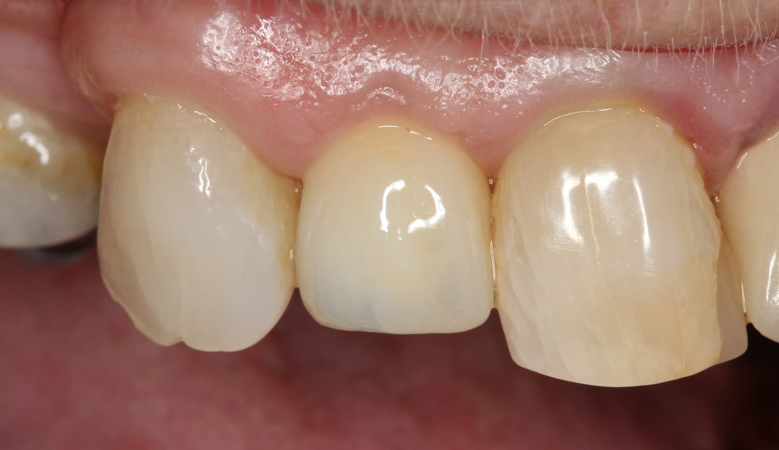 After dental implants treatment