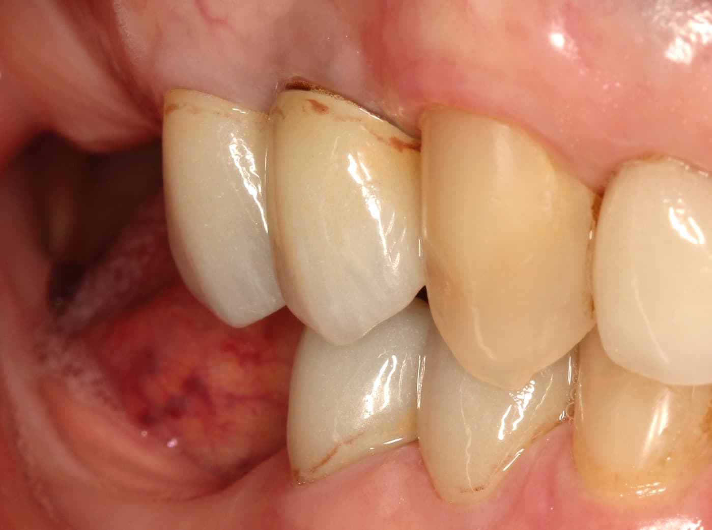 After dental implants treatment