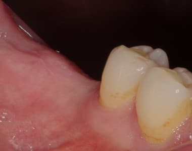 Before dental implants treatment