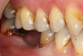 Before dental implants treatment