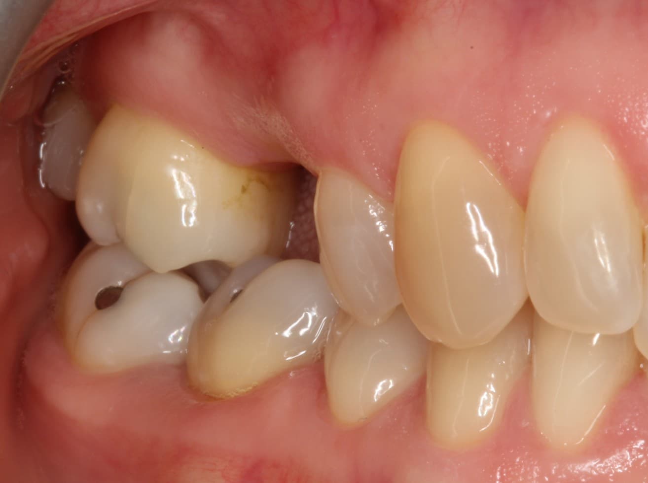 Before dental implants treatment