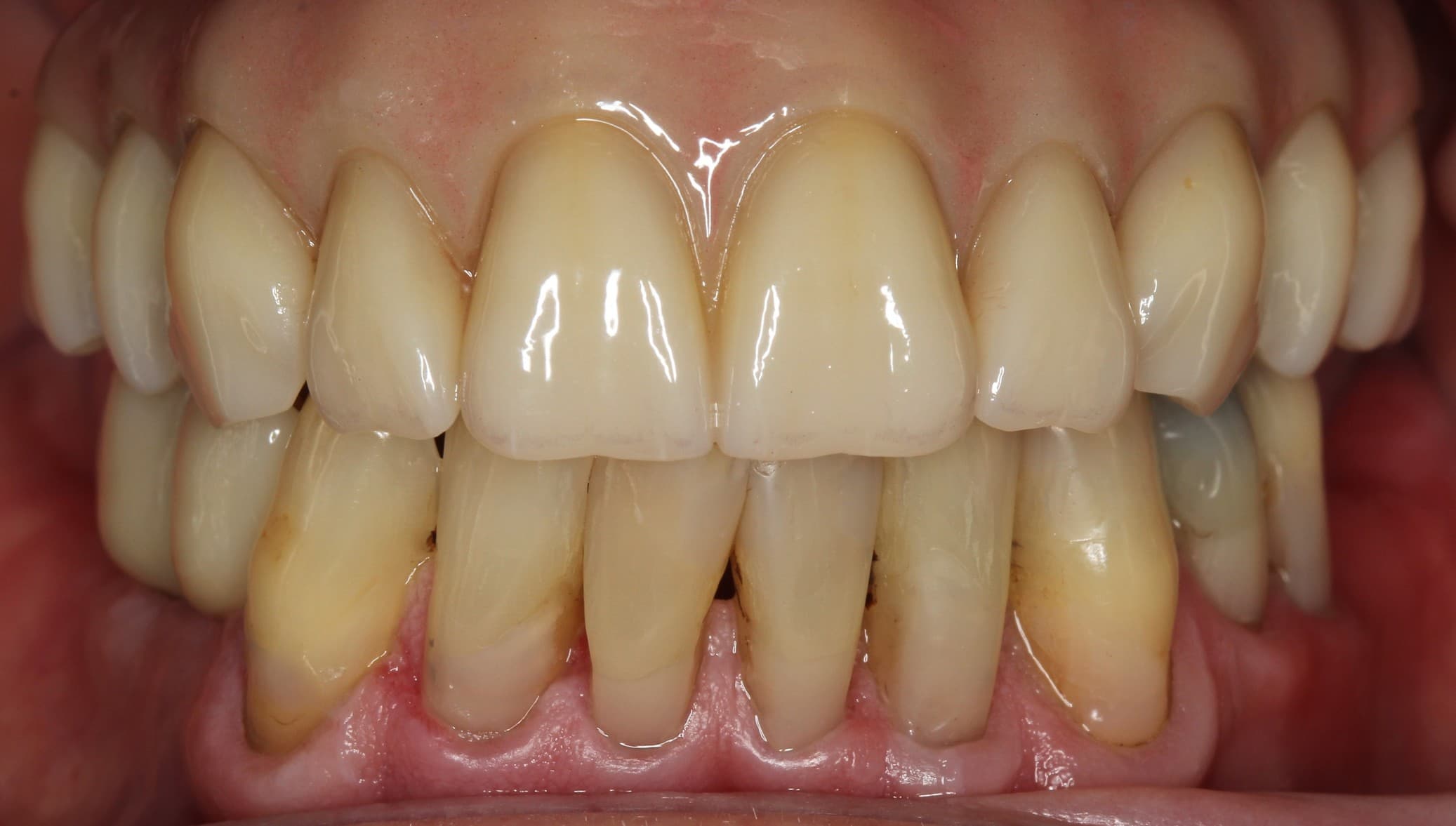 After full-mouth implants treatment
