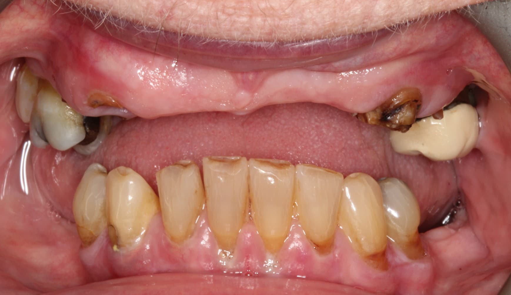Before full-mouth implants treatment