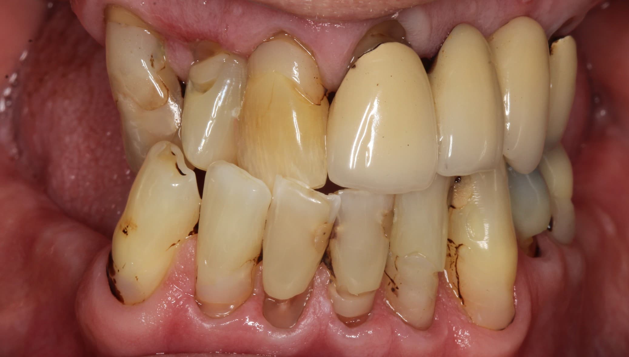 Before full-mouth implants treatment