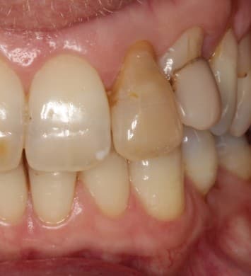 Before internal bleaching treatment