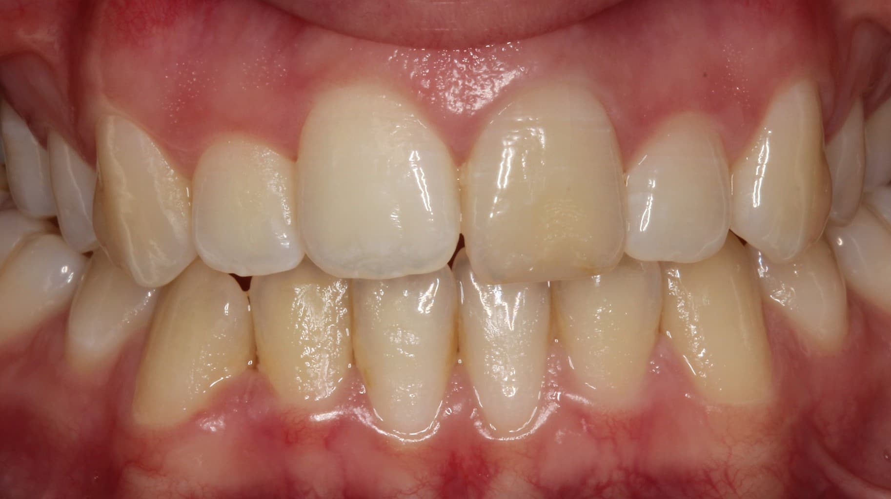 Before internal bleaching treatment