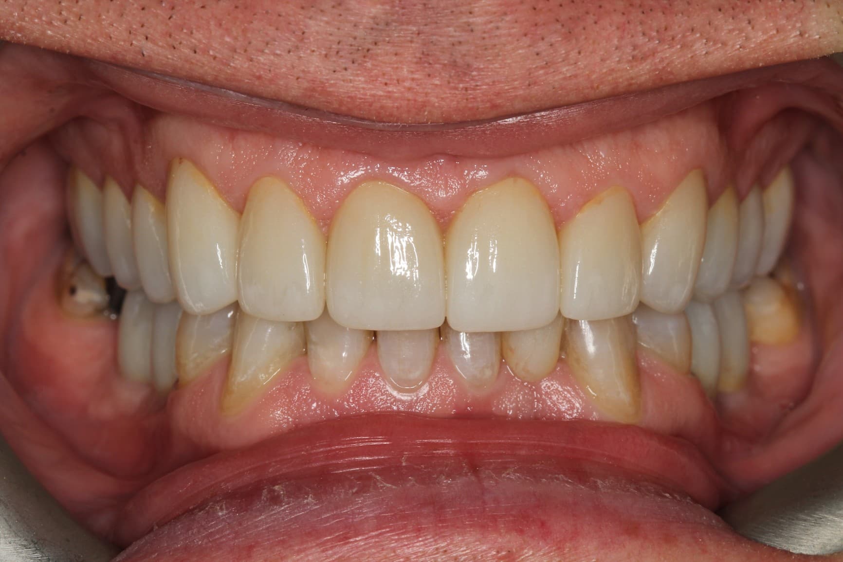 After porcelain veneers treatment
