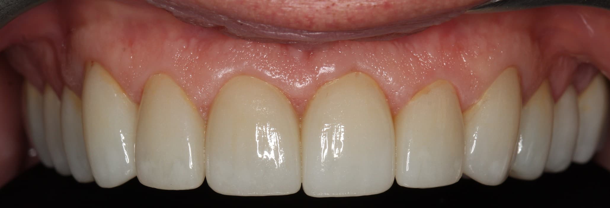 After porcelain veneers treatment