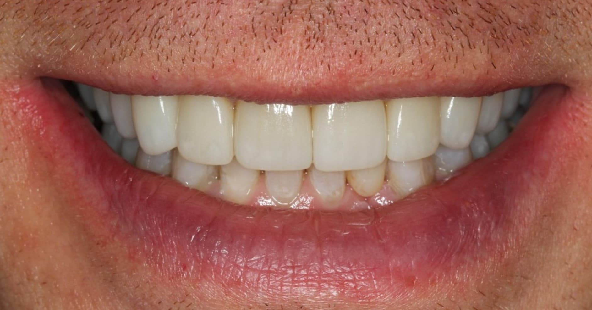 After porcelain veneers treatment