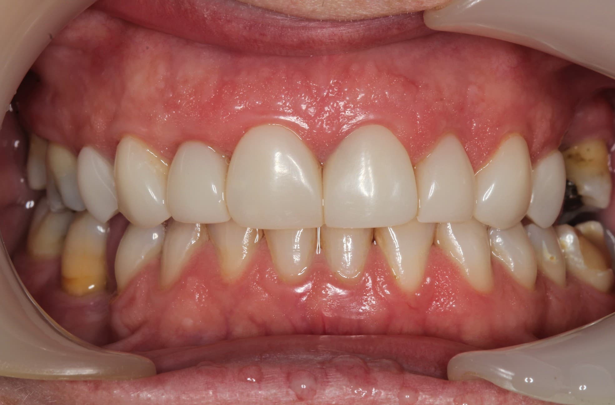 After porcelain veneers treatment
