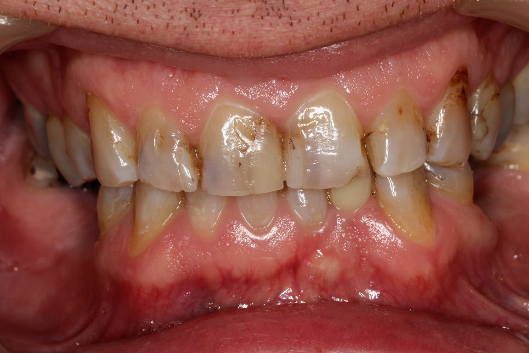 Before porcelain veneers treatment