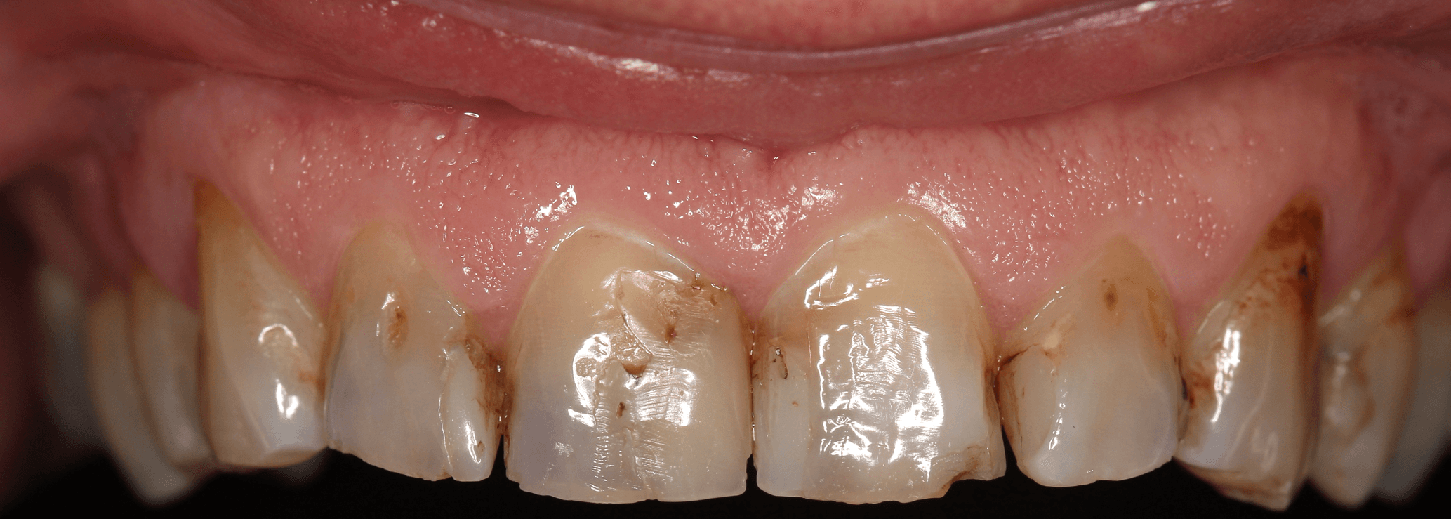 Before porcelain veneers treatment