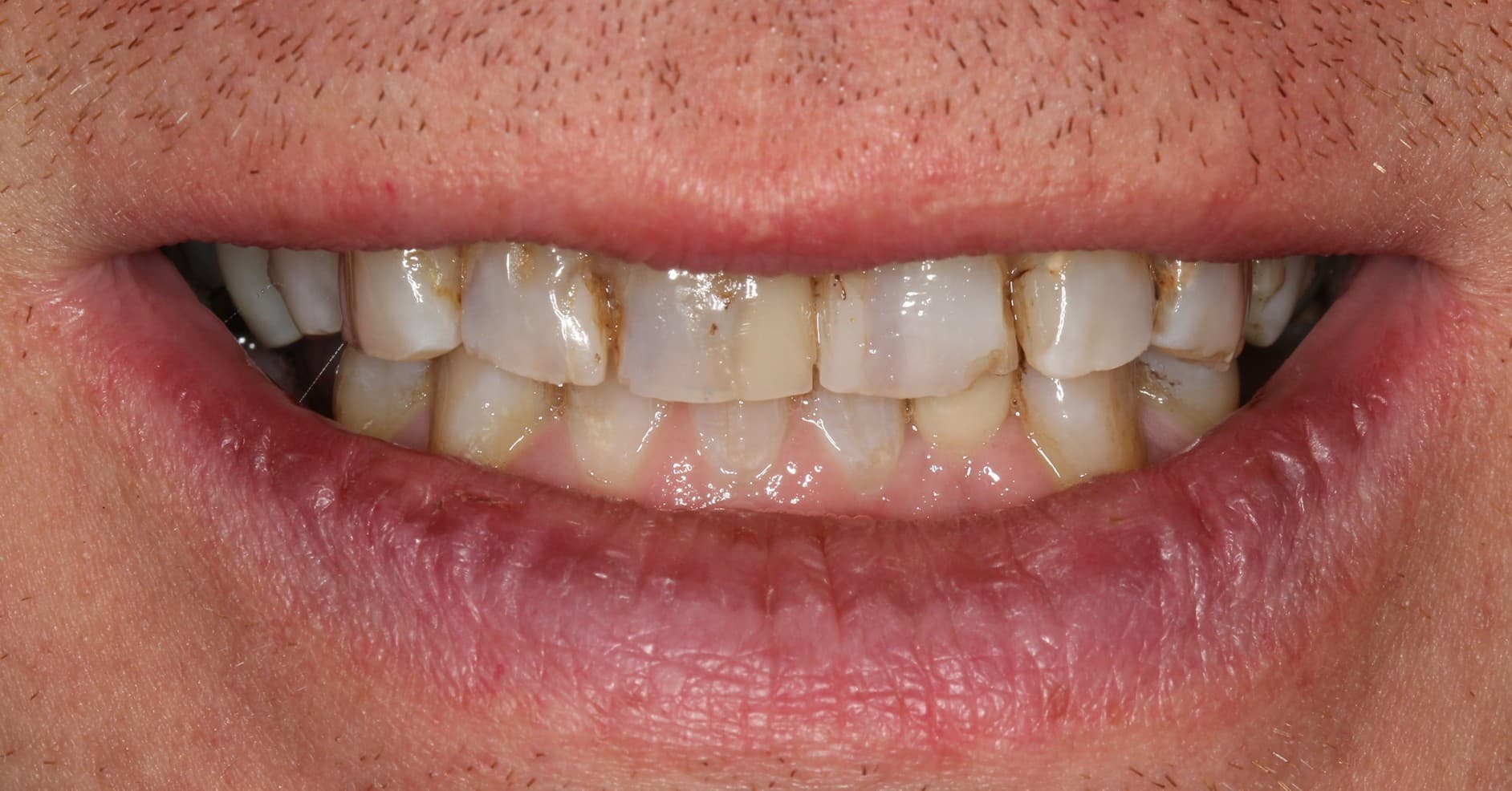 Before porcelain veneers treatment