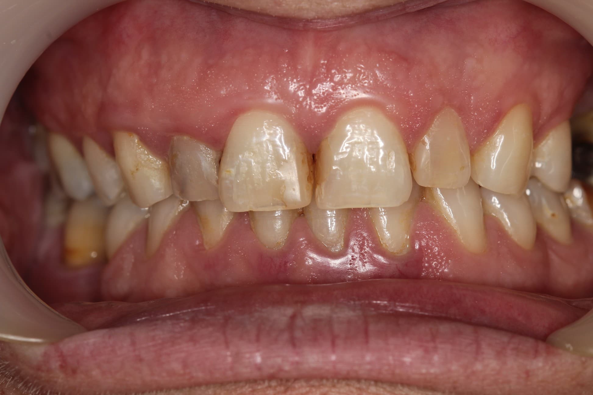 Before porcelain veneers treatment