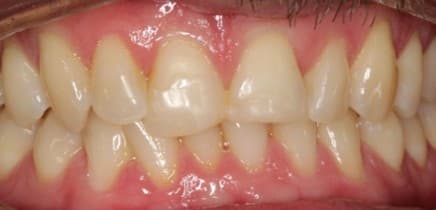 Before porcelain veneers treatment